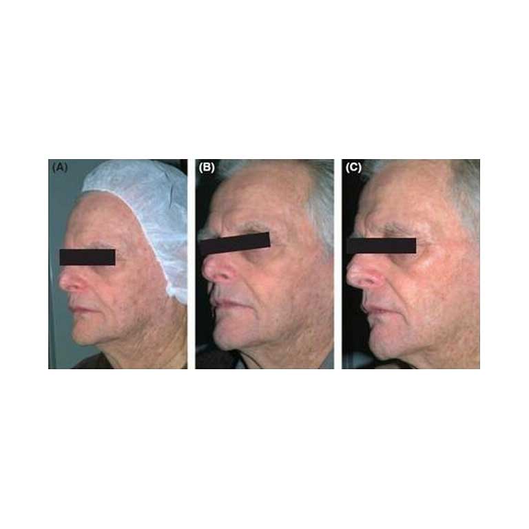 Multi Wave LED Light Therapy w/ RF/MicroCurrent/Hot/Cold Hammer - Image 2